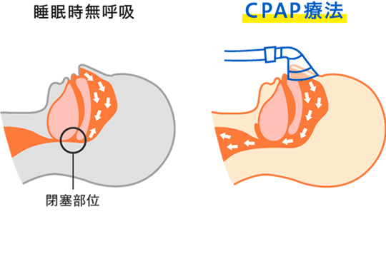CPAP療法