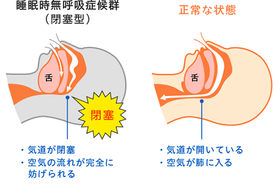睡眠時無呼吸症候群
